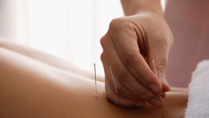 Everything you need to know about Dry Needling